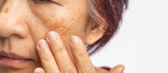 Menopausal women worry about melasma on face.