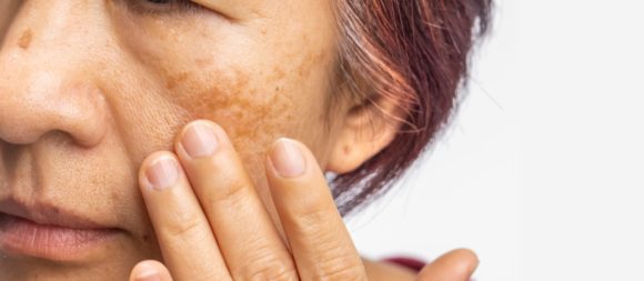 Menopausal women worry about melasma on face. Menopausal women worry about melasma on face.